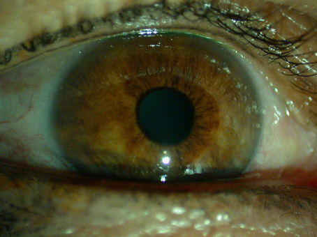 yeux vairons